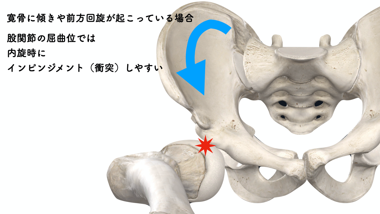 股関節のインピンジメント