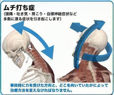 ムチ打ち損傷