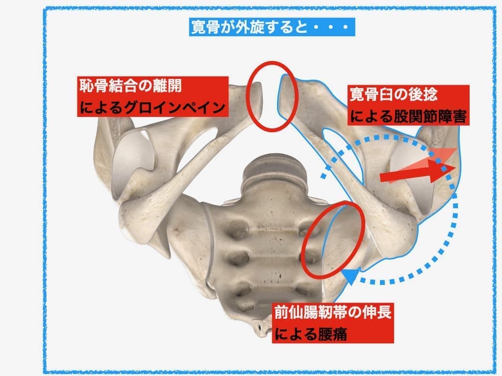 仙腸関節障害による症状