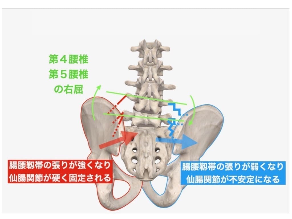 仙腸関節の不安定性
