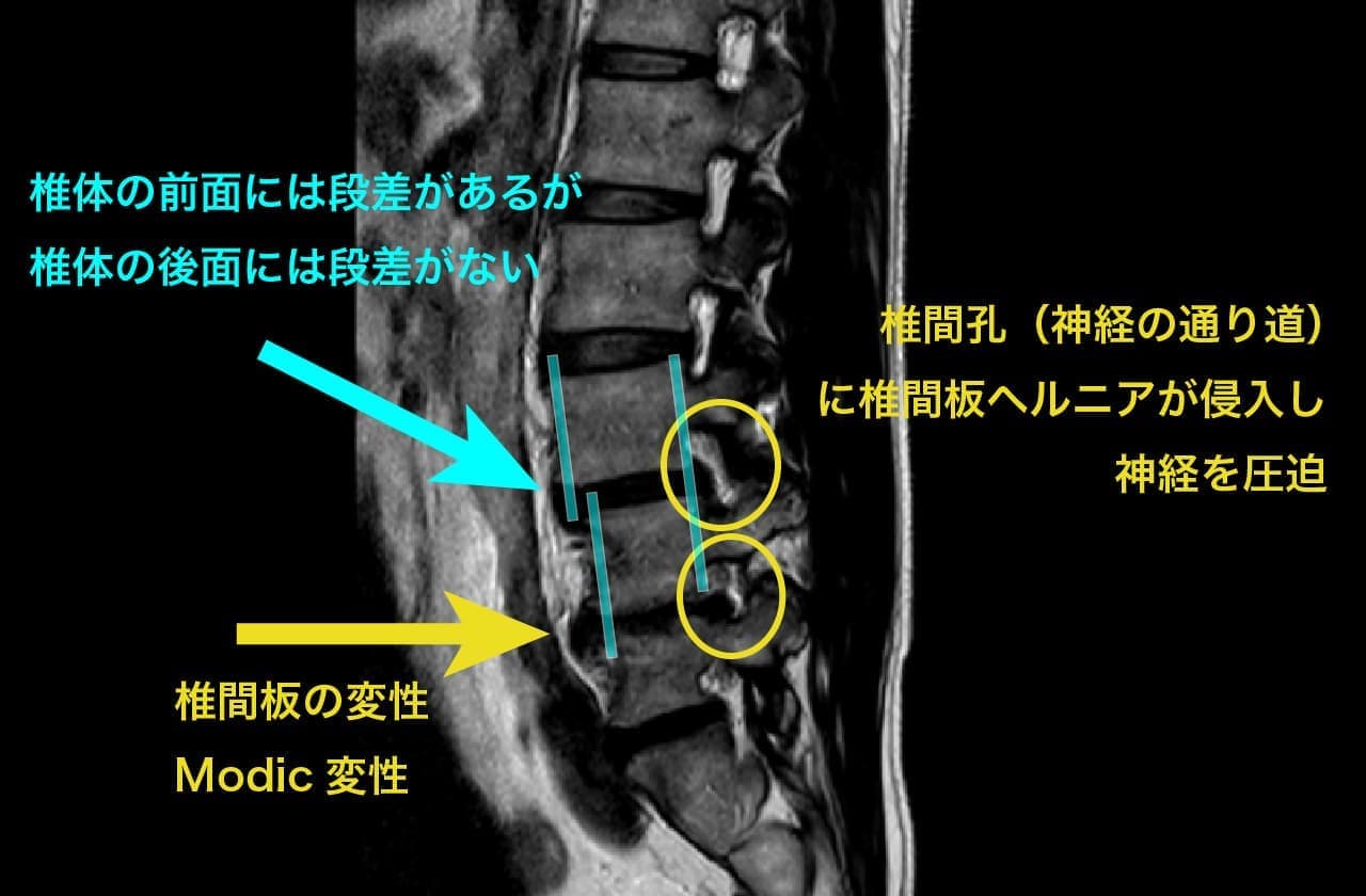 腰痛・坐骨神経痛・椎間板ヘルニア