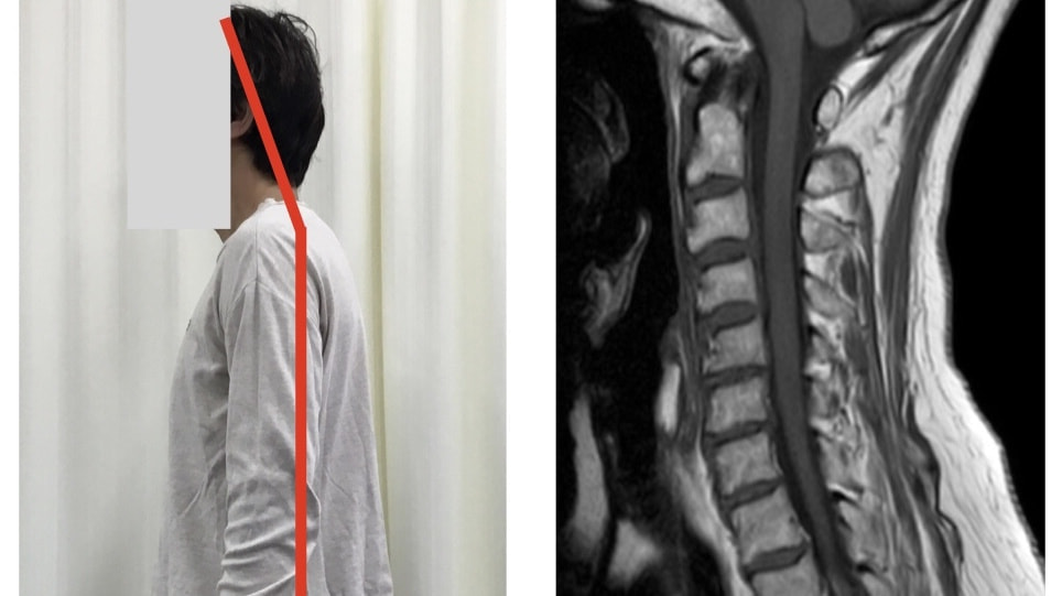 肩甲上腕リズム