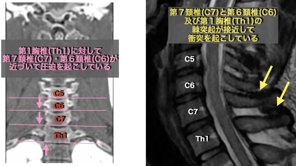 肩甲上腕リズム