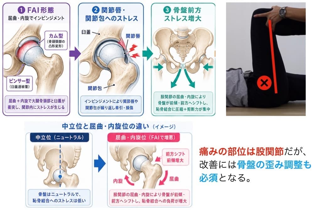 股関節のインピンジメント
