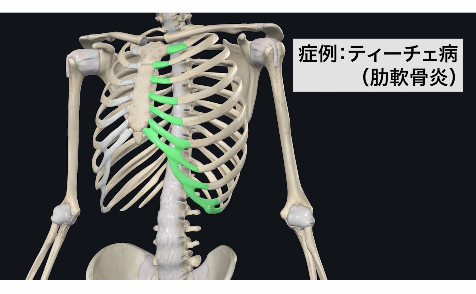 ティーツェ病原因 – 胸の真ん中が痛い 息苦しい _ 肋軟骨炎またはティーツェ病について – NQZJBQ